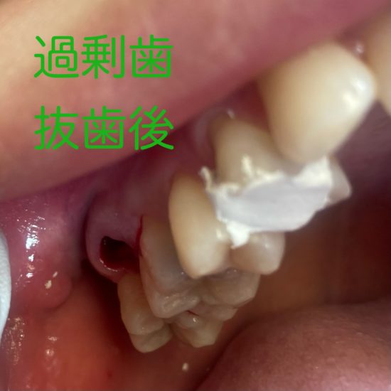 過剰歯　抜歯