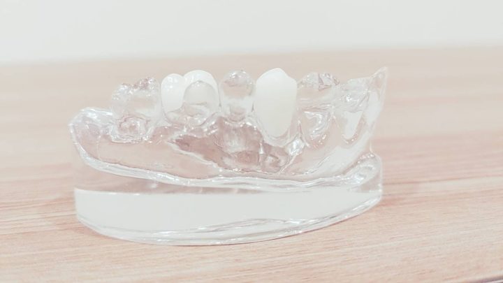 セラミックの歯　イーマックス　e-max 　ジルコニア