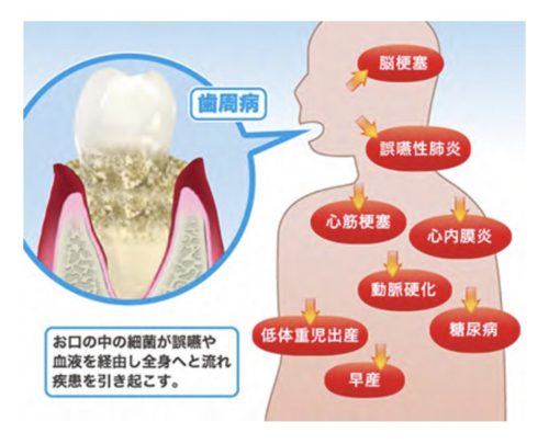 歯周病と全身疾患