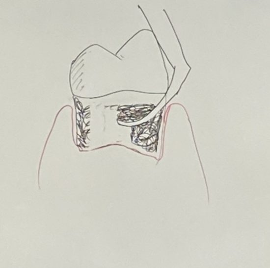 歯周病治療