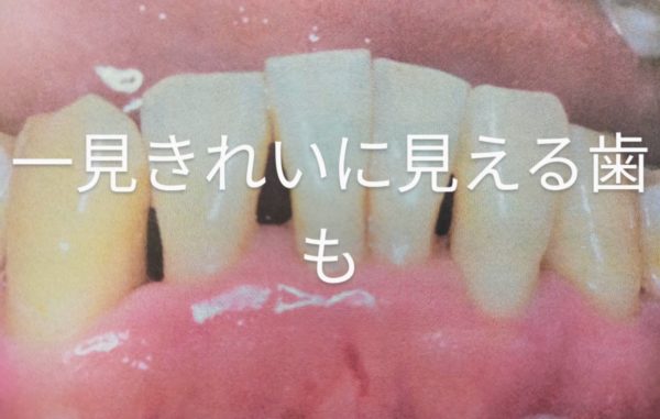 染めだし 歯周病