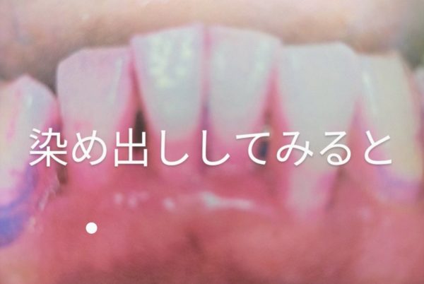 染めだし 歯周病