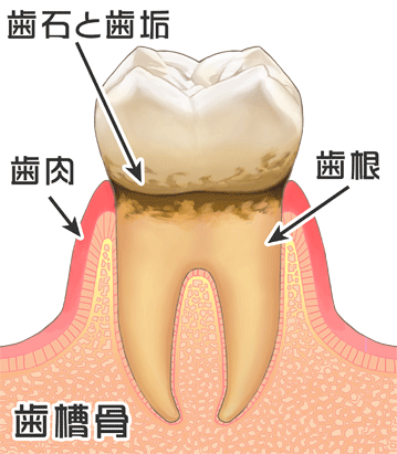 歯周病