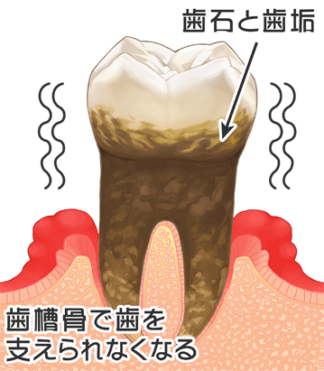 歯周病