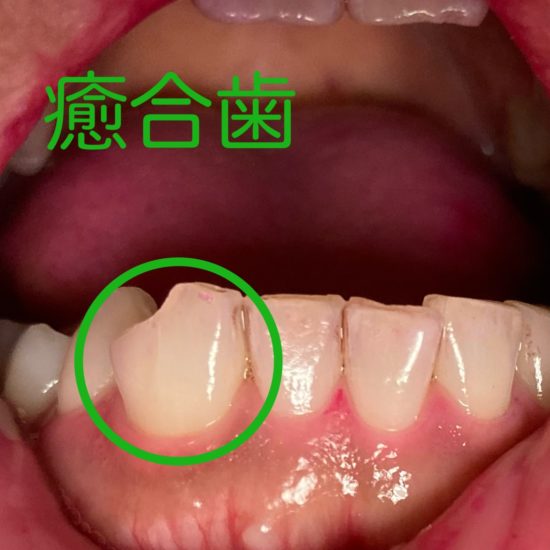 永久歯の癒合歯