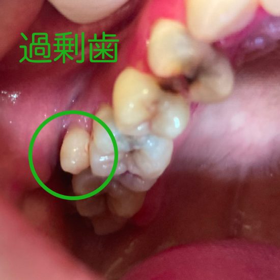 過剰歯 抜歯